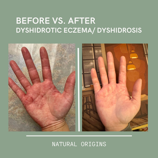 I can see a huge difference in my dyshidrotic eczema that has spread from my fingers to my palms on both of my hands.